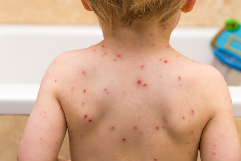Comment calmer la varicelle naturellement ?