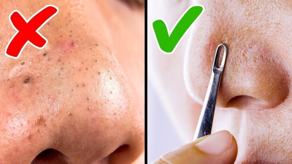 Comment éliminer les points noirs sur le nez naturellement ?