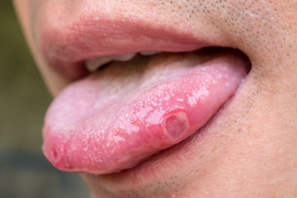 Quelle est la cause des aphtes dans la bouche ?