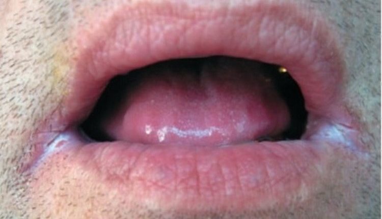 Comment savoir si on a une infection dans la bouche ?